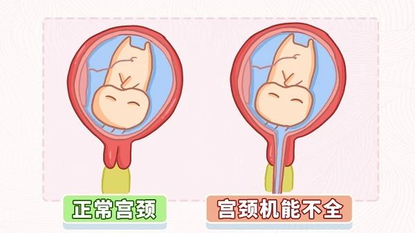 北京家恩德仁医院：怀孕后宫颈变短会早产吗？